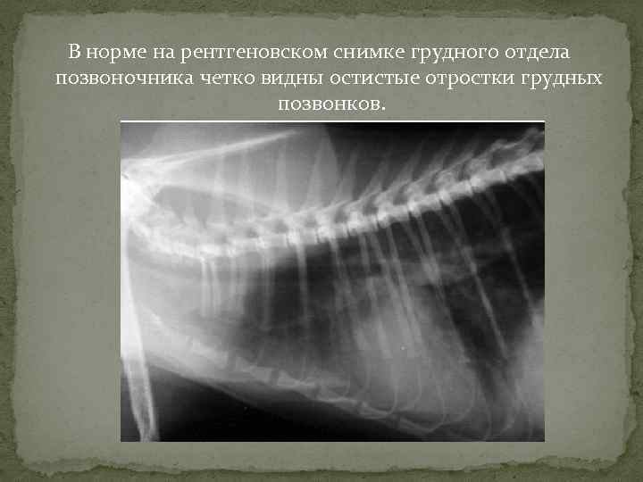 В норме на рентгеновском снимке грудного отдела позвоночника четко видны остистые отростки грудных позвонков.