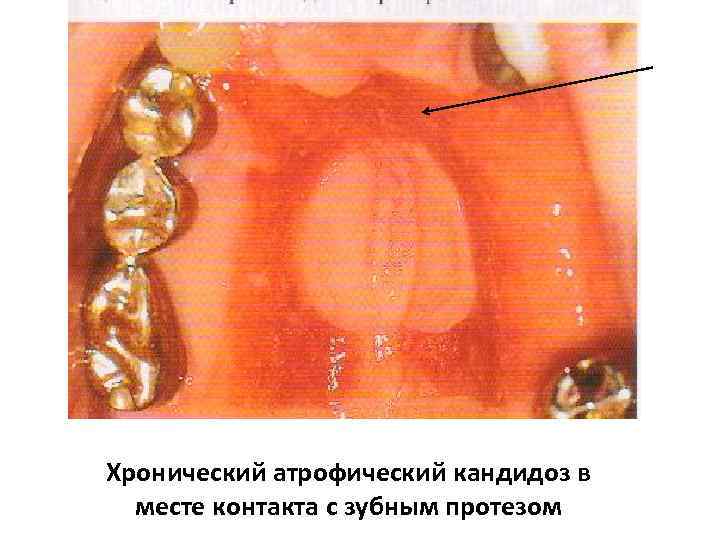 Кандидоз слизистой рта фото