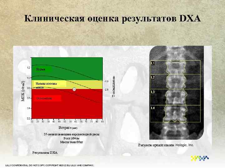 Клиническая картина остеопороза