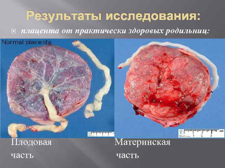 Результаты исследования: плацента от практически здоровых родильниц: § Плодовая часть Материнская часть 