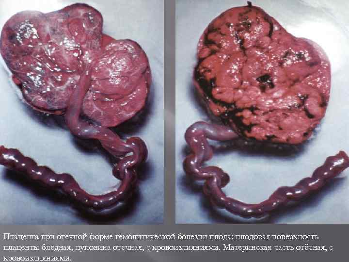 Плацента при отечной форме гемолитической болезни плода: плодовая поверхность плаценты бледная, пуповина отечная, с