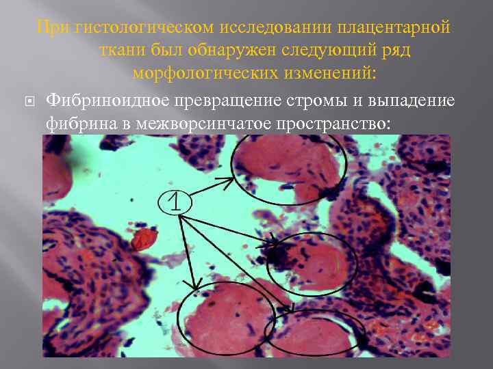 При гистологическом исследовании плацентарной ткани был обнаружен следующий ряд морфологических изменений: Фибриноидное превращение стромы