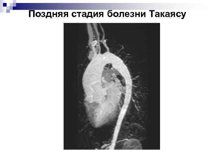 Поздняя стадия болезни Такаясу 