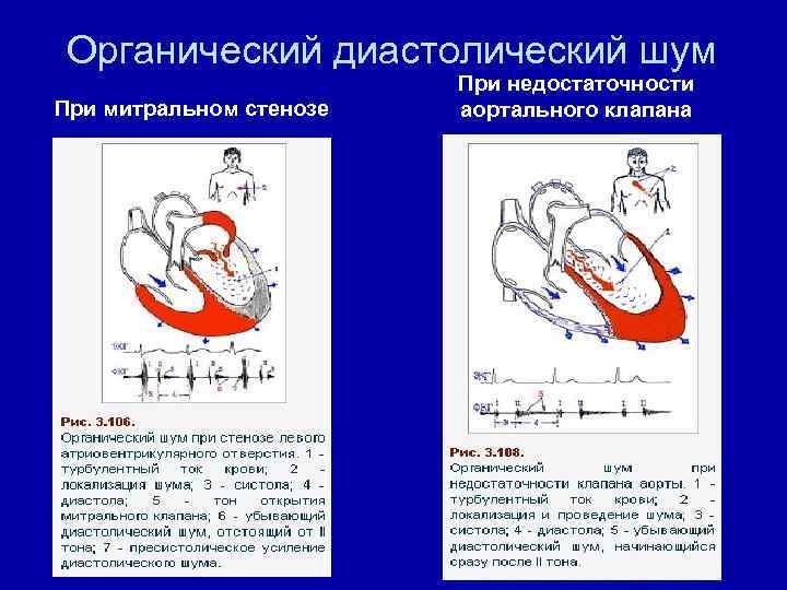 Шум на митральном клапане