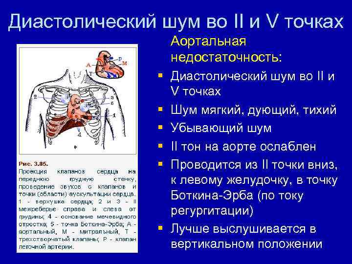 Диастолический шум во II и V точках Аортальная недостаточность: § Диастолический шум во II