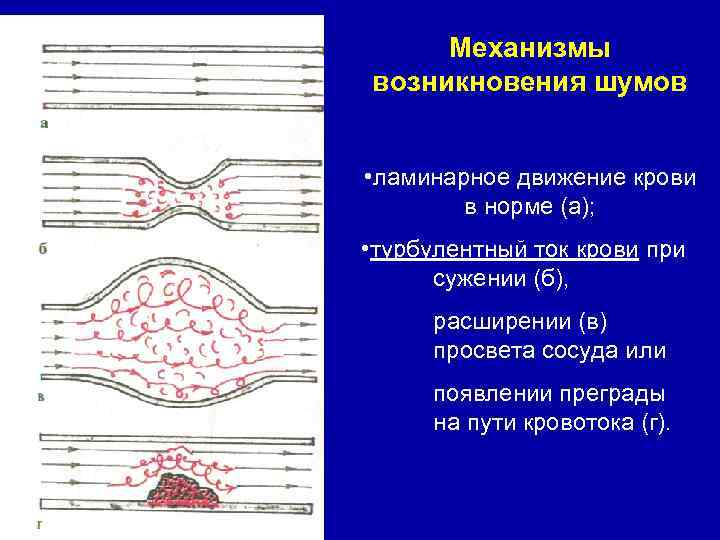 Механизмы возникновения шумов • ламинарное движение крови в норме (а); • турбулентный ток крови