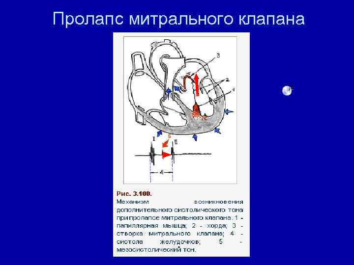 Пролапс митрального клапана 