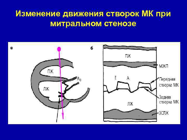 Изменение движения створок МК при митральном стенозе 