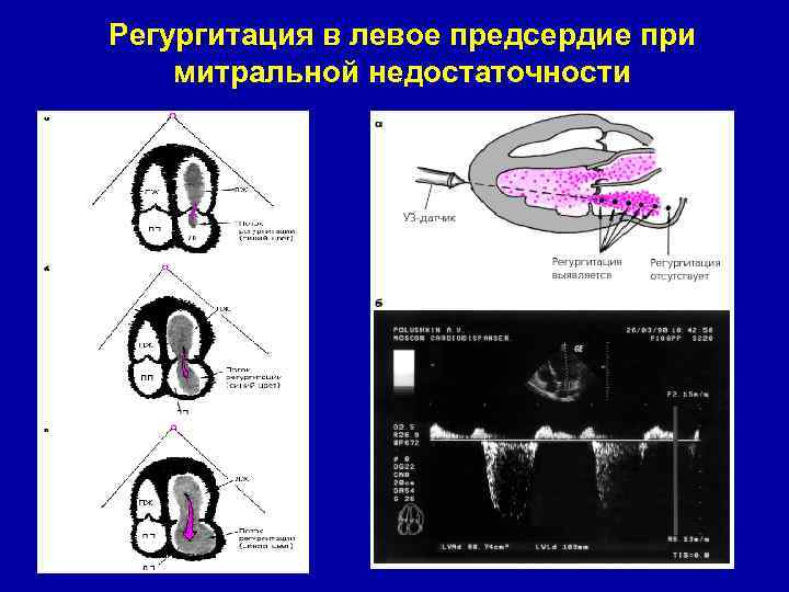 Регургитация в левое предсердие при митральной недостаточности 