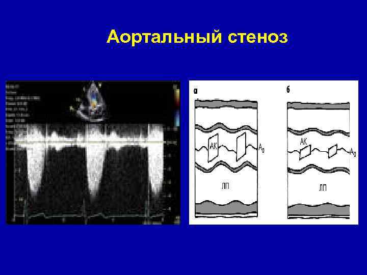 Аортальный стеноз 