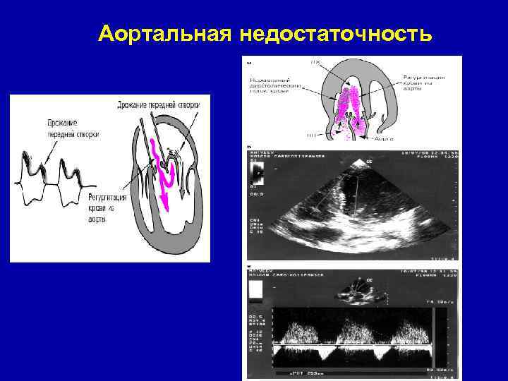 Голос эхо сделать. Сердечные шумы пропедевтика. Шумы сердца пропедевтика. Эхо голоса.