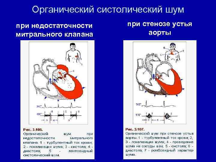 Аускультативная картина митральной недостаточности тест с ответами