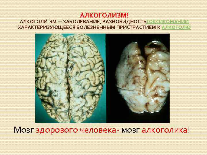 АЛКОГОЛИЗМ! АЛКОГОЛИ ЗМ — ЗАБОЛЕВАНИЕ, РАЗНОВИДНОСТЬ ТОКСИКОМАНИИ ХАРАКТЕРИЗУЮЩЕЕСЯ БОЛЕЗНЕННЫМ ПРИСТРАСТИЕМ К АЛКОГОЛЮ Мозг здорового