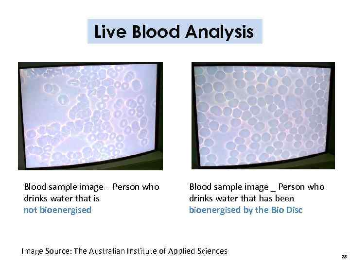 Live Blood Analysis Blood sample image – Person who drinks water that is not