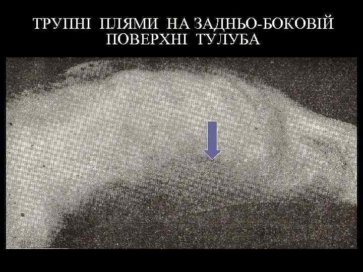 ТРУПНІ ПЛЯМИ НА ЗАДНЬО-БОКОВІЙ ПОВЕРХНІ ТУЛУБА 