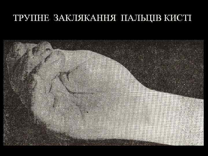 ТРУПНЕ ЗАКЛЯКАННЯ ПАЛЬЦІВ КИСТІ 