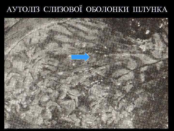 АУТОЛІЗ СЛИЗОВОЇ ОБОЛОНКИ ШЛУНКА 