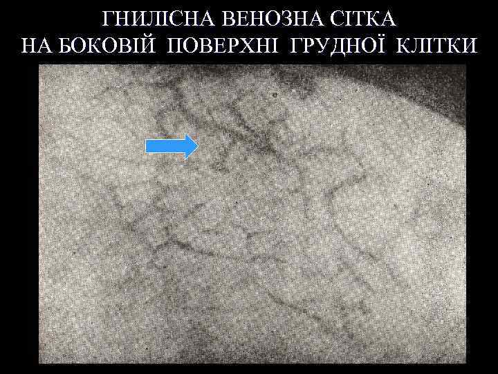 ГНИЛІСНА ВЕНОЗНА СІТКА НА БОКОВІЙ ПОВЕРХНІ ГРУДНОЇ КЛІТКИ 