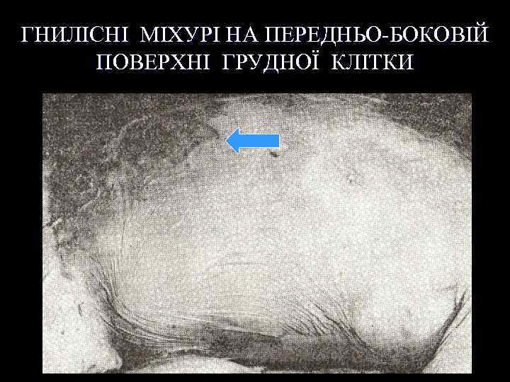 ГНИЛІСНІ МІХУРІ НА ПЕРЕДНЬО-БОКОВІЙ ПОВЕРХНІ ГРУДНОЇ КЛІТКИ 