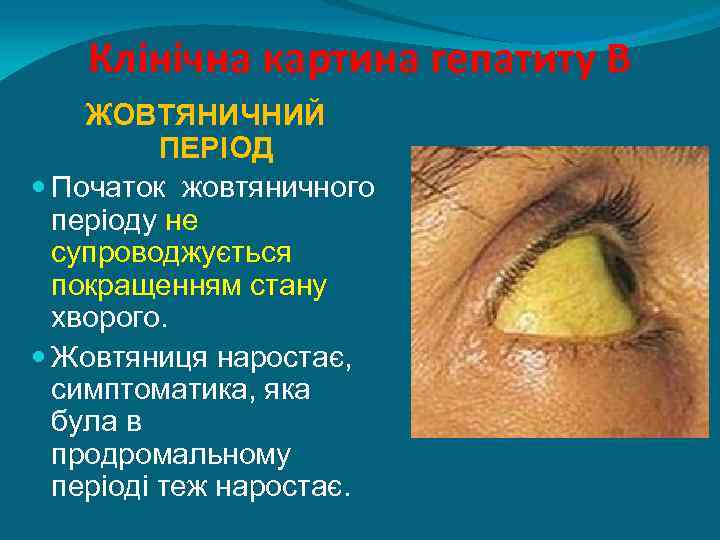 Клінічна картина гепатиту В ЖОВТЯНИЧНИЙ ПЕРІОД Початок жовтяничного періоду не супроводжується покращенням стану хворого.