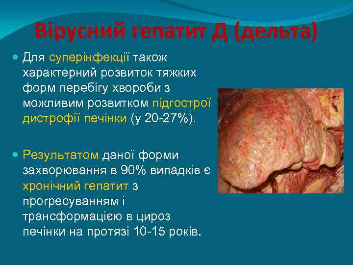 Вірусний гепатит Д (дельта) Для суперінфекції також характерний розвиток тяжких форм перебігу хвороби з