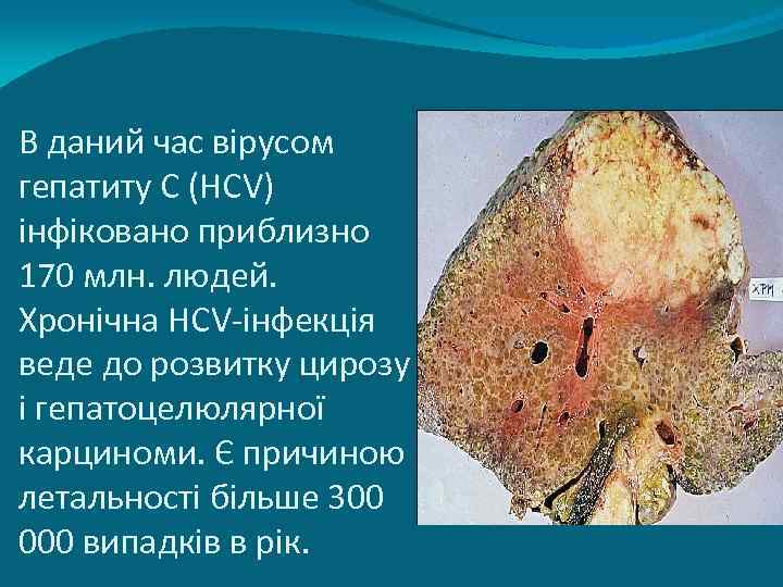 В даний час вірусом гепатиту С (НСV) інфіковано приблизно 170 млн. людей. Хронічна НСV-інфекція