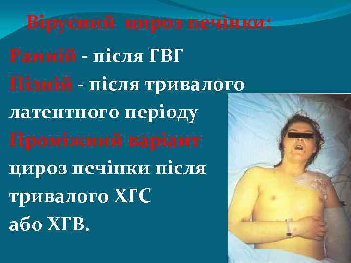 Вірусний цироз печінки: Ранній - після ГВГ Пізній - після тривалого латентного періоду Проміжний