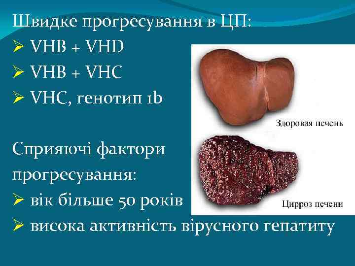 Швидке прогресування в ЦП: Ø VHB + VHD Ø VHB + VHC Ø VHC,