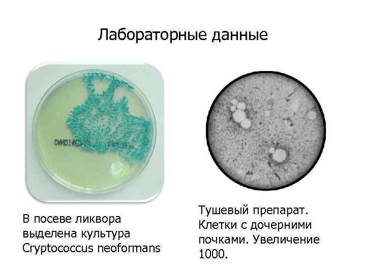 Лабораторные данные В посеве ликвора выделена культура Cryptococcus neoformans Тушевый препарат. Клетки с дочерними