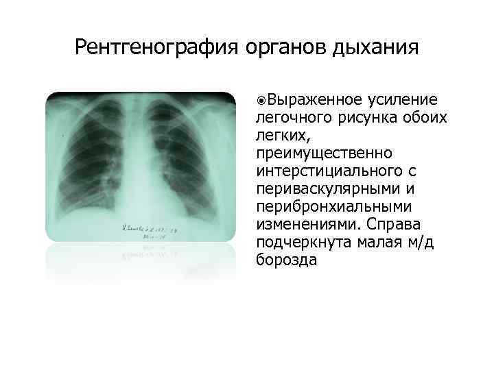 Рентгенография органов дыхания Выраженное усиление легочного рисунка обоих легких, преимущественно интерстициального с периваскулярными и