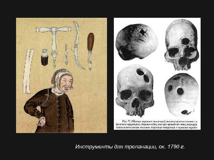 Инструменты для трепанации, ок. 1790 г. 
