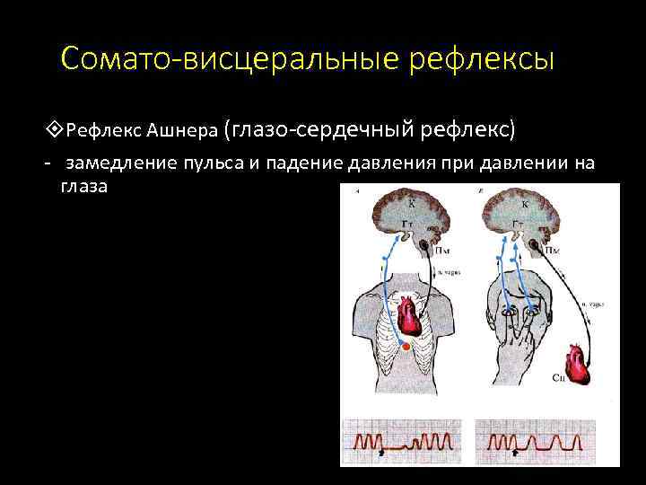 Сомато-висцеральные рефлексы Рефлекс Ашнера (глазо-сердечный рефлекс) - замедление пульса и падение давления при давлении