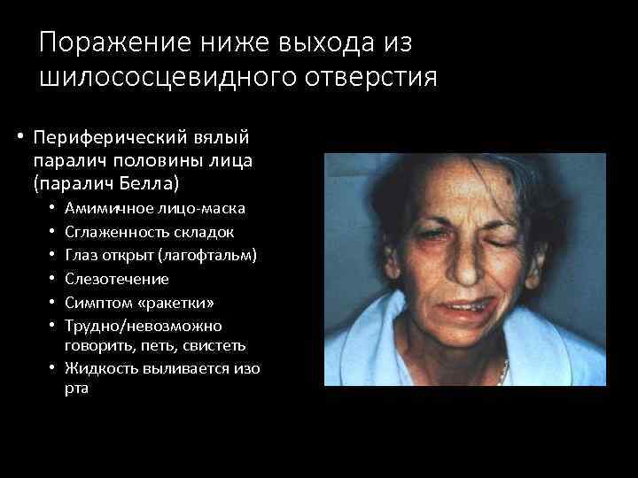 Поражение ниже выхода из шилососцевидного отверстия • Периферический вялый паралич половины лица (паралич Белла)