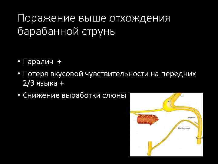 Поражение выше отхождения барабанной струны • Паралич + • Потеря вкусовой чувствительности на передних