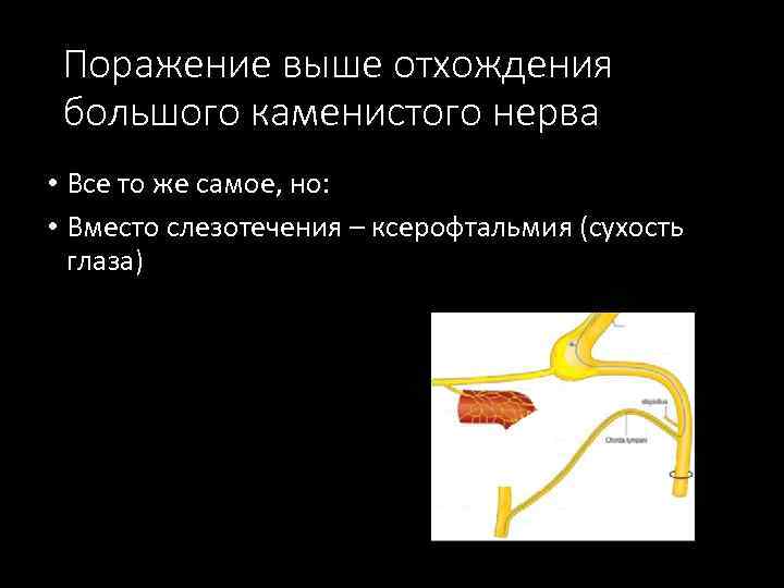 Поражение выше отхождения большого каменистого нерва • Все то же самое, но: • Вместо