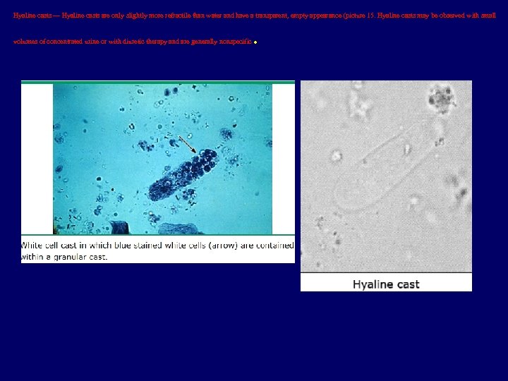 Hyaline casts — Hyaline casts are only slightly more refractile than water and have