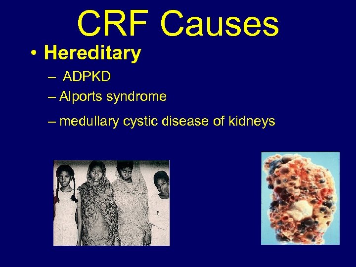 CRF Causes • Hereditary – ADPKD – Alports syndrome – medullary cystic disease of