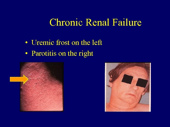 Chronic Renal Failure • Uremic frost on the left • Parotitis on the right