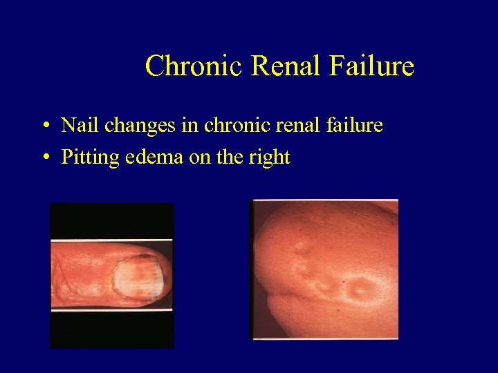 Chronic Renal Failure • Nail changes in chronic renal failure • Pitting edema on