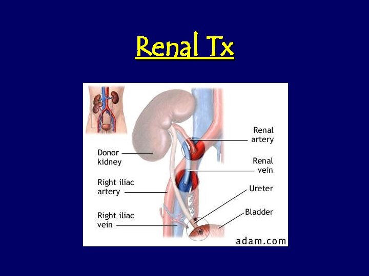 Renal Tx 