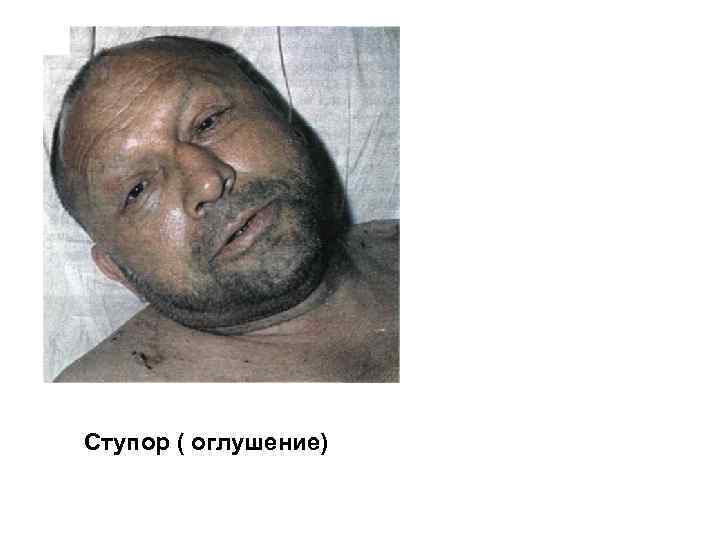 Ступор ( оглушение) 
