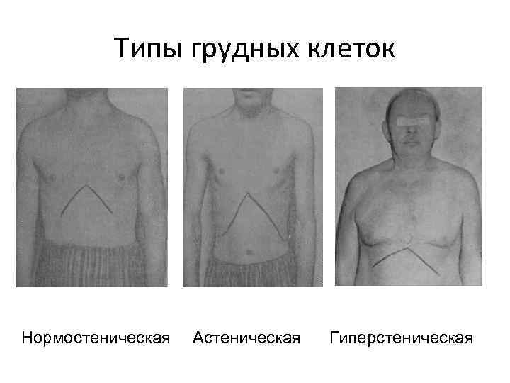 Типы грудных клеток Нормостеническая Астеническая Гиперстеническая 