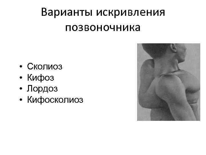 Варианты искривления позвоночника • • Сколиоз Кифоз Лордоз Кифосколиоз 