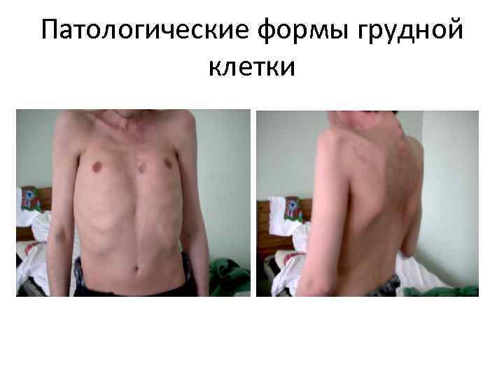 Патологические формы грудной клетки 