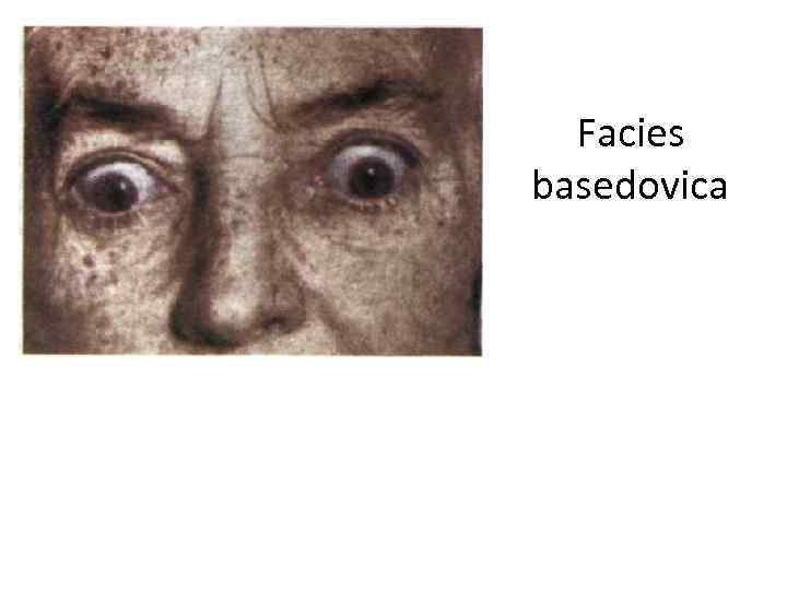 Facies basedovica 