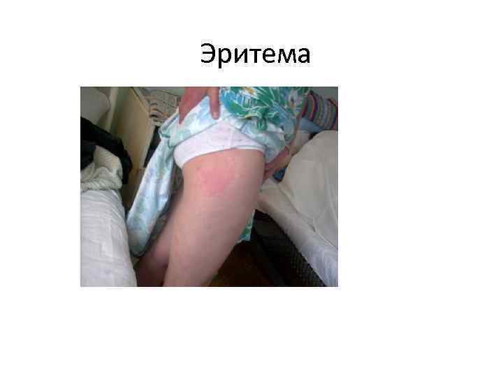Эритема 