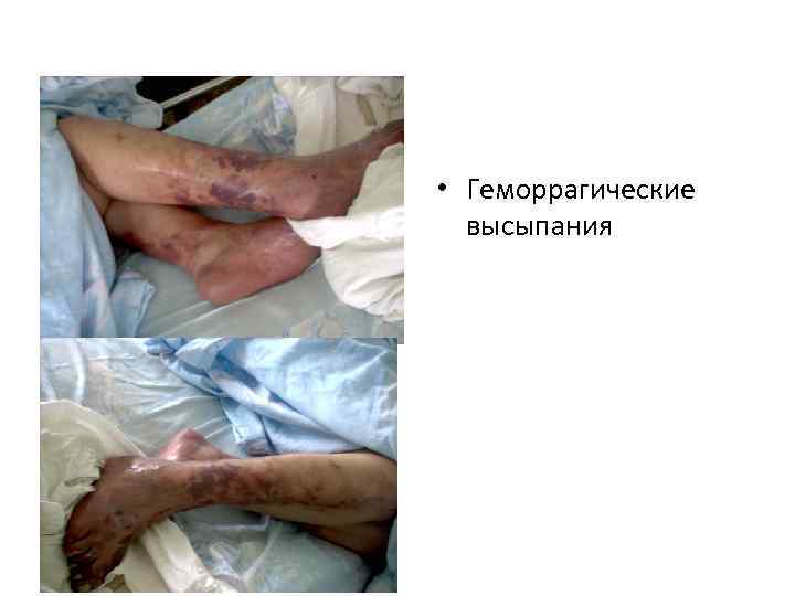  • Геморрагические высыпания 