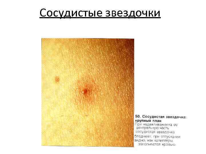 Сосудистые звездочки 