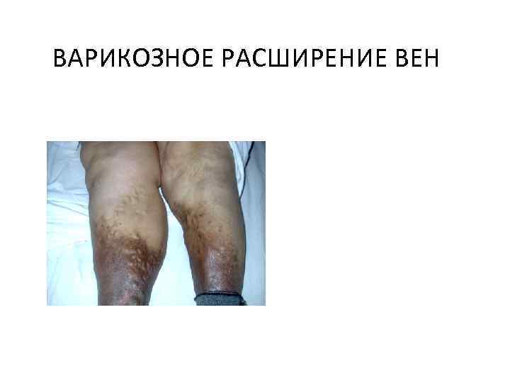 ВАРИКОЗНОЕ РАСШИРЕНИЕ ВЕН 