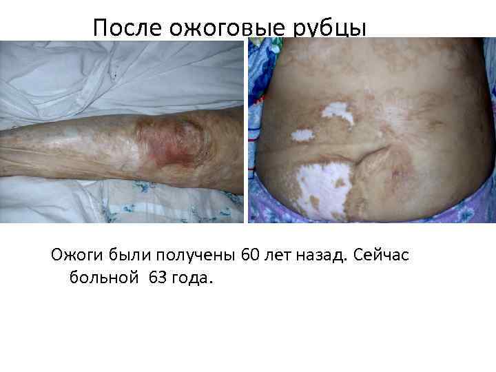 После ожоговые рубцы Ожоги были получены 60 лет назад. Сейчас больной 63 года. 